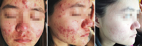 广州肤康皮肤病医院