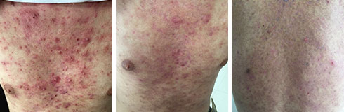 广州肤康皮肤病医院