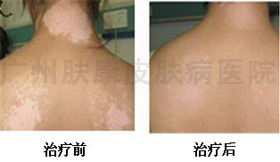 广州肤康皮肤病医院