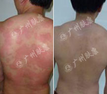 广州肤康皮肤病医院