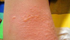 广州肤康皮肤病医院