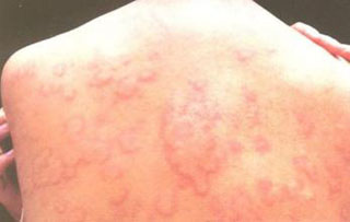 广州肤康皮肤病医院