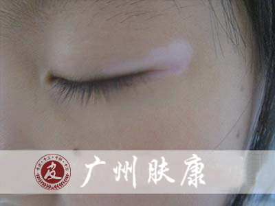 广州肤康皮肤病医院