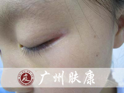 广州肤康皮肤病医院