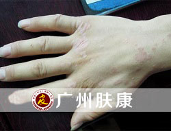 广州肤康皮肤病医院