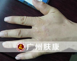 广州肤康皮肤病医院