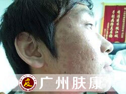 广州肤康皮肤病医院
