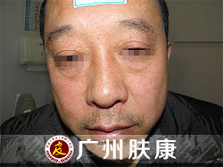 广州肤康皮肤病医院