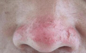 广州肤康皮肤病医院