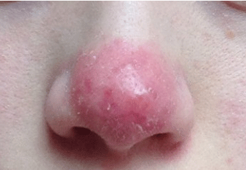 广州肤康皮肤病医院