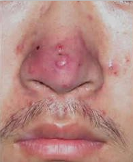 广州肤康皮肤病医院