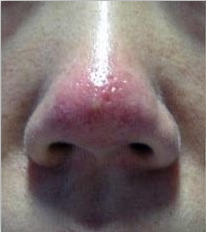 广州肤康皮肤病医院