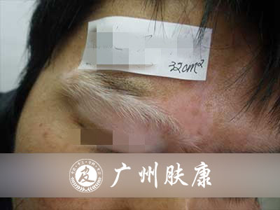 广州肤康皮肤病医院