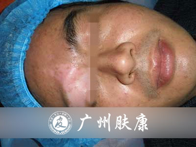 广州肤康皮肤病医院