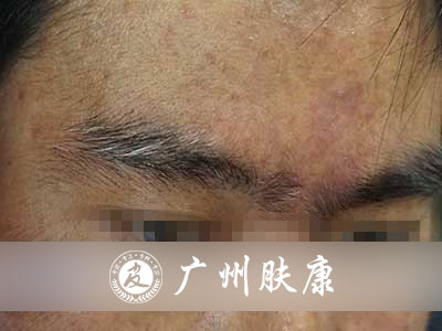 广州肤康皮肤病医院