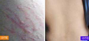 广州肤康皮肤病医院